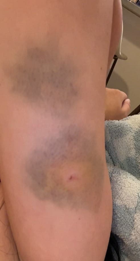 Reganne's Bruises